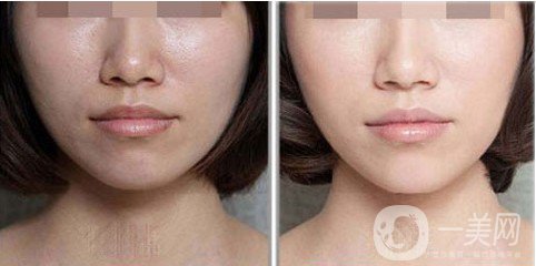 鐳射激光嫩膚是什么 主要有哪些作用？