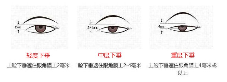 上瞼下垂矯治術(shù)*果怎么做 保持多久？