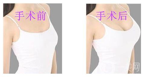 假體隆胸的恢復(fù)時(shí)間是多久？