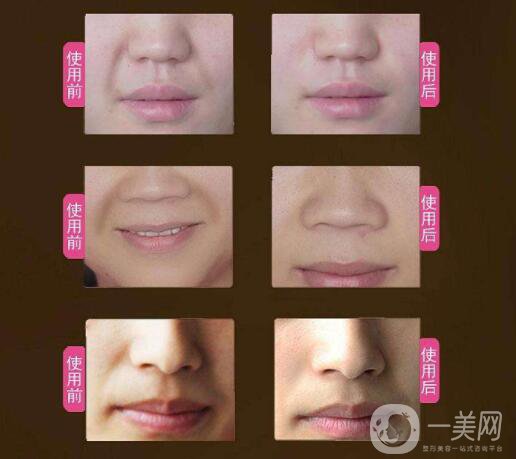 玻尿酸去法令紋的價(jià)錢 時(shí)間保持久嗎？