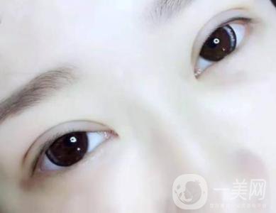 雙眼皮術(shù)后如何防止增生 雙眼皮術(shù)后護(hù)理