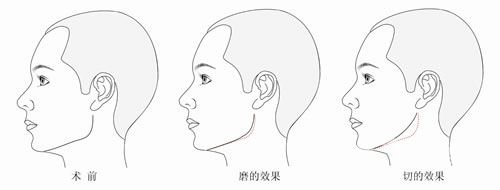 下頜角磨骨多久能喝酒 下頜角磨骨恢復(fù)時(shí)間