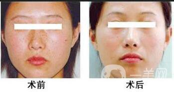 復合彩光調節(jié)*果,復合彩光調節(jié)禁忌人群