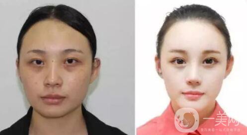 光子嫩膚的優(yōu)勢 光子嫩膚有風險嗎？