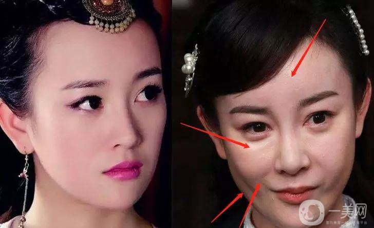 明星整容就是不承認？ 然后突然臉“爛”了！