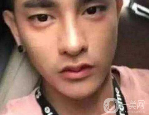 小伙整容數(shù)十次，只為一張韓星臉