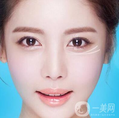 注射去皺后時間久了皺紋會變得更糟嗎？