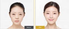開內(nèi)外眼角果如何？開眼角前后照片