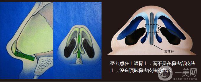 醫(yī)生測(cè)評(píng)：自體隆鼻專(zhuān)家 張笑天