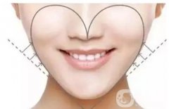 面部吸脂修復(fù)手術(shù)多少錢 面部吸脂恢復(fù)時間
