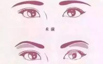 深圳假體豐眉弓手術(shù)費用 眉弓手術(shù)*嗎