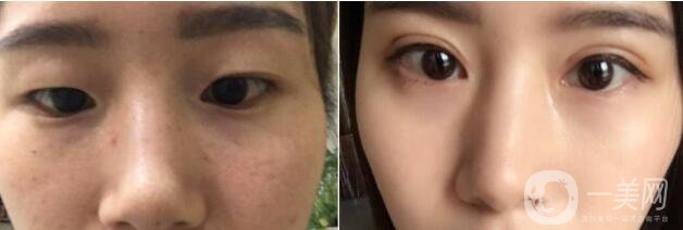 杭州割雙眼皮價(jià)格 割雙眼皮的方法
