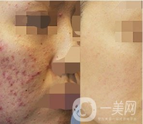 磨皮祛痘坑*果好嗎？去痘坑前后