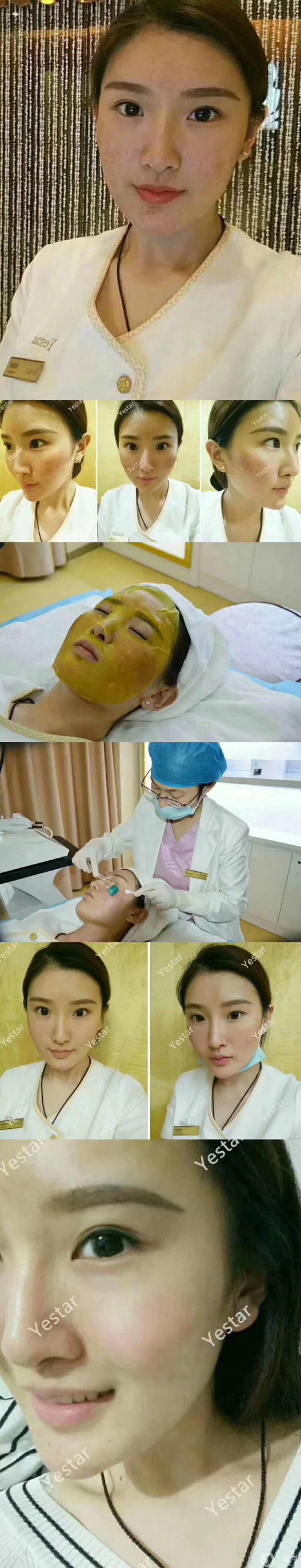 磨皮祛痘坑*果好嗎？去痘坑前后