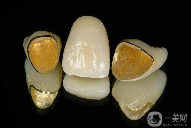 黃金烤瓷牙價格一般是多少？