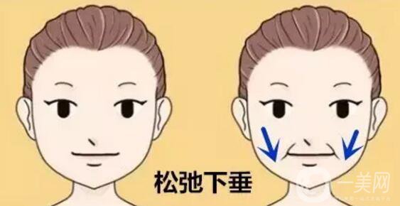 法令紋怎么祛除*果比較好？