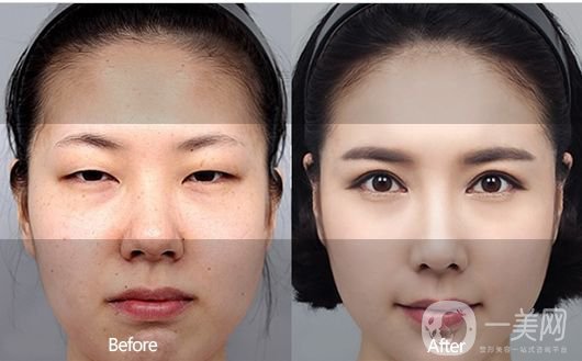 埋線雙眼皮好不好？埋線雙眼皮*果圖
