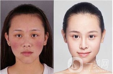臉上很多紅血絲怎么辦？給你1個小法寶和紅血絲說再見