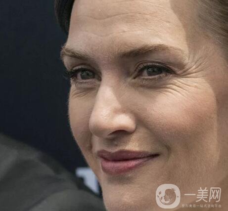 祛除眼角魚尾紋方法有哪些？價(jià)格一般是多少呢？