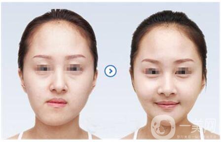 正頜手術(shù)的方法有哪些？