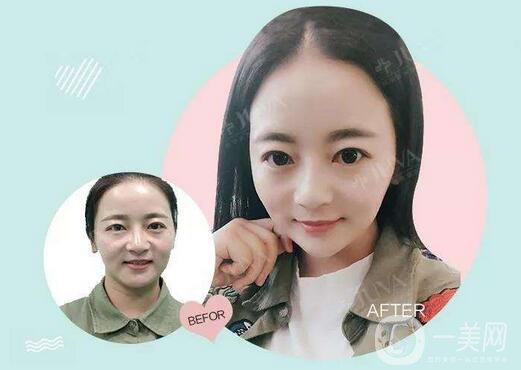 關(guān)于注射美容，你得了解這幾點干貨！