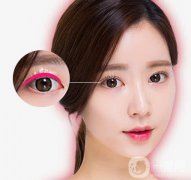 亞韓割雙眼皮多少錢？什么人不適合做這項(xiàng)手術(shù)呢？