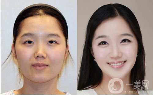 班加羅爾面部頸部抽脂術(shù)怎么樣 價(jià)格是多少？