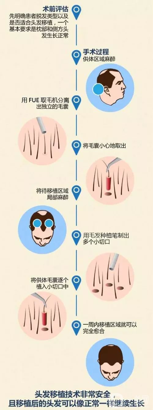 毛發(fā)移植*果怎么樣？毛發(fā)移植原理是什么？