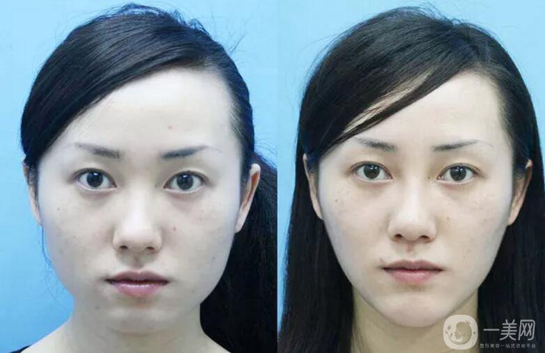 下頜角磨骨整形價(jià)格貴嗎？需要多少錢？