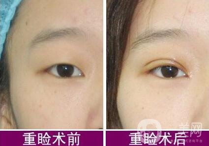5s重瞼術和全切的區(qū)別 5s重瞼術是*的嗎
