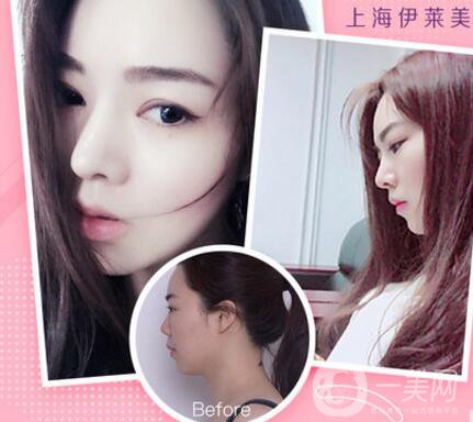 上海伊萊美口碑怎么樣？是正規(guī)醫(yī)院嗎？