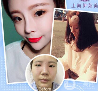上海伊萊美口碑怎么樣？是正規(guī)醫(yī)院嗎？
