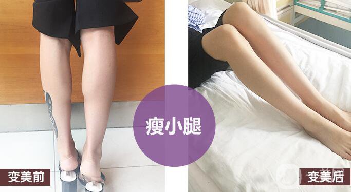 打*有副作用嗎？都有哪些副作用呢？