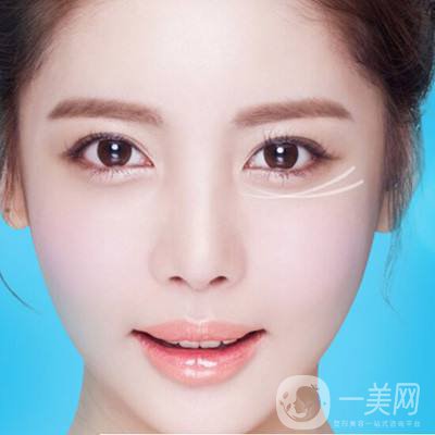深圳去眼袋手術(shù)多少錢(qián) 去眼袋有什么風(fēng)險(xiǎn)嗎？
