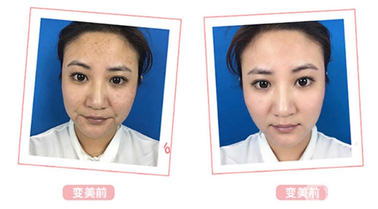 光子嫩膚*果介紹？對皮膚會有傷害嗎？