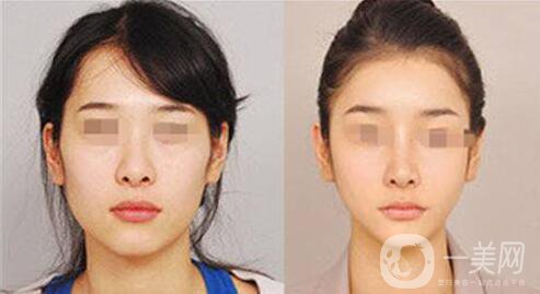 下頜整形手術(shù)的方法有哪些？