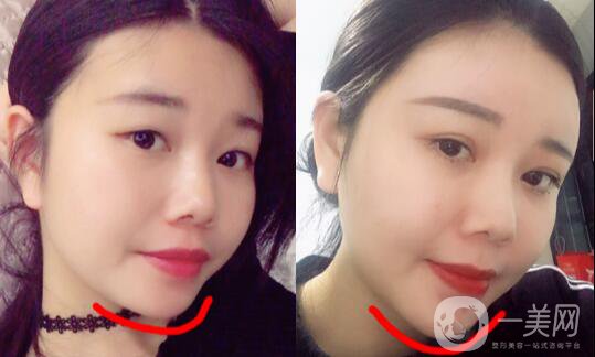 自體脂肪墊下巴恢復(fù)期是怎樣的？如何做好術(shù)后護(hù)理？