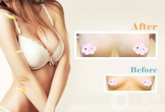 乳房提升怎么樣 隆胸手術(shù)時間是多久