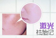激光去胎記的恢復(fù)過(guò)程 激光去胎記的方法
