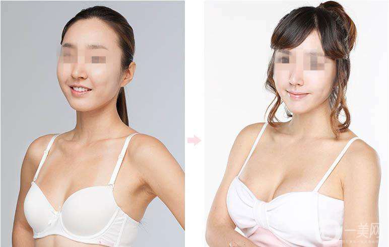 假體隆胸貴嗎 假體隆胸手術費用是多少