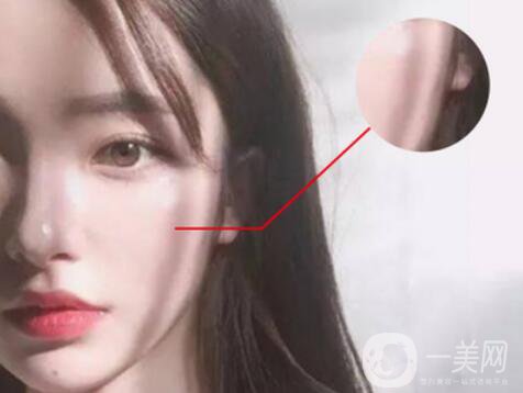 磨顴骨*果怎么樣 有什么風(fēng)險(xiǎn)嗎？