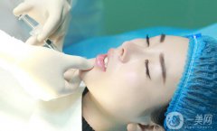 自體脂肪墊下巴貴嗎 一般多少錢？