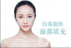面部自體脂肪填充貴嗎？一般多少錢(qián)？