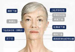 注射瘦臉生物除皺價格是多少 果怎么樣