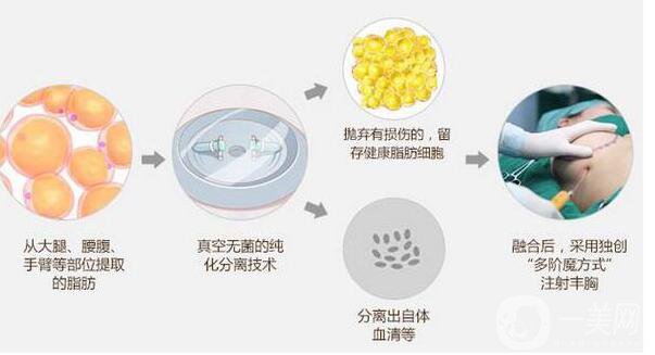 自體脂肪隆胸價格 自體脂肪豐胸后的危害