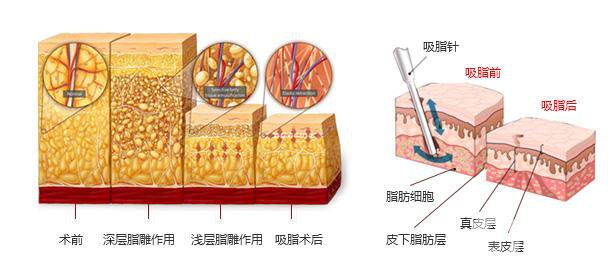 吸脂減肥價(jià)格 吸脂減肥適合什么人