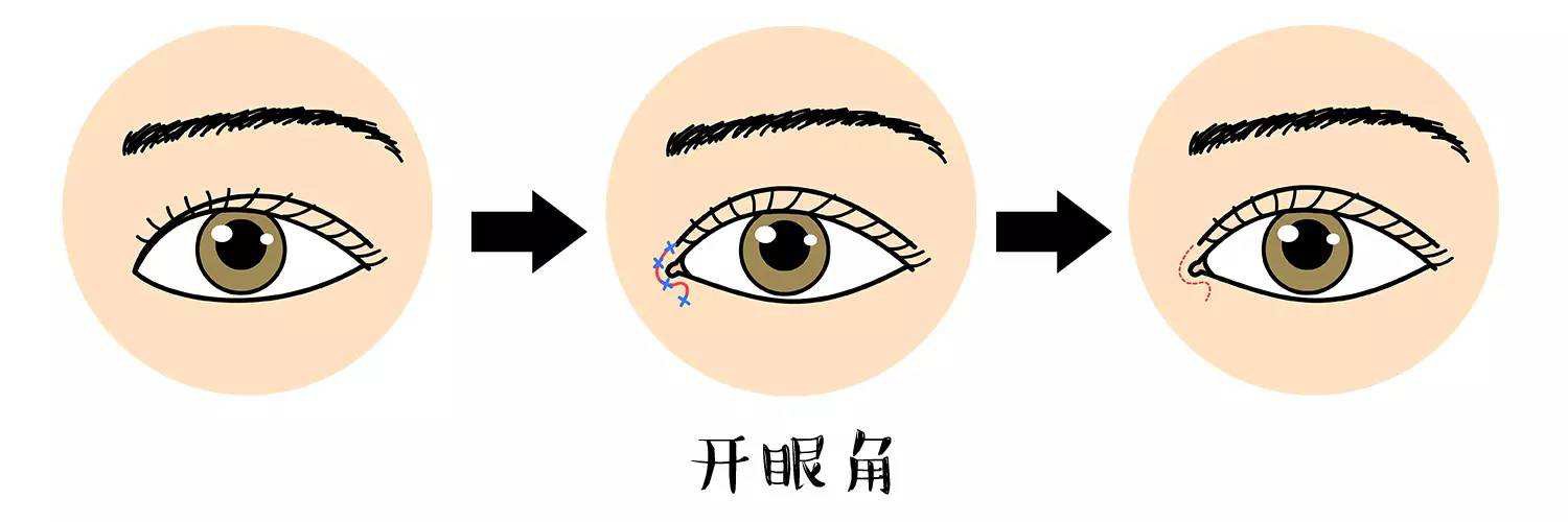 開眼角手術前后圖 開眼角注意事項