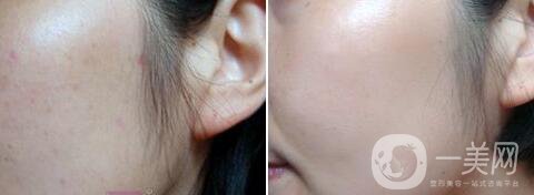 點(diǎn)痣多少錢(qián)一顆 點(diǎn)痣后要注意什么