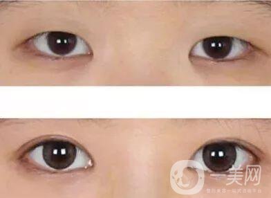 開(kāi)眼角