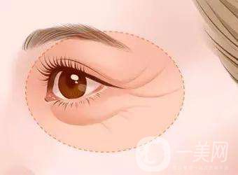 眼部除皺手術(shù)方法有哪些 眼部除皺有副作用嗎